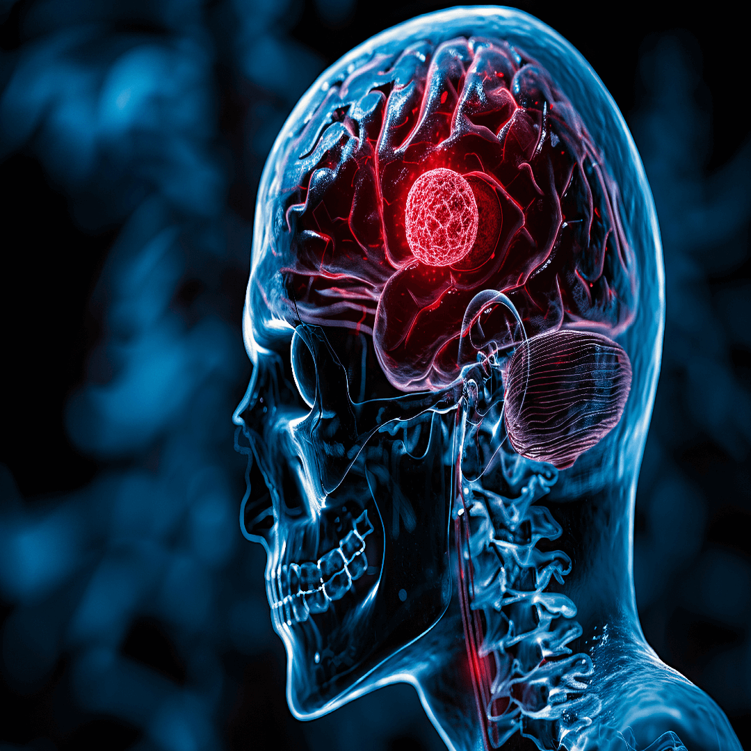 brain-tumor