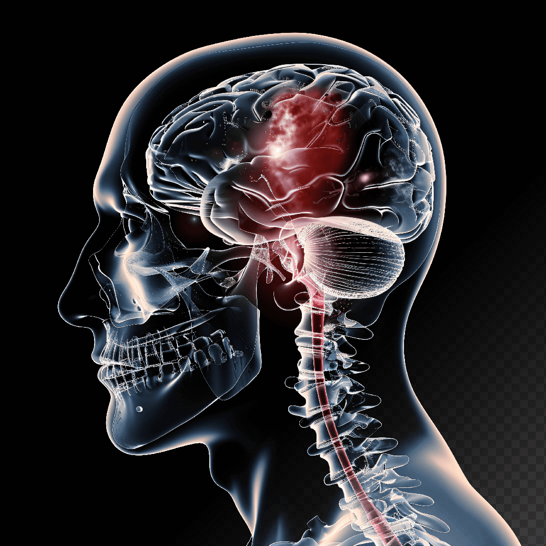 brain-tumor