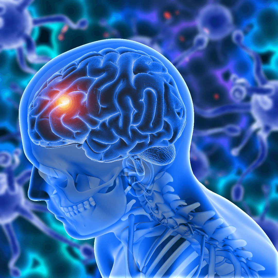brain-tumor
