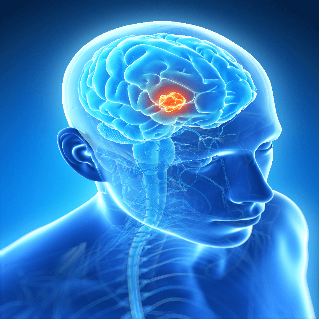 brain-tumor