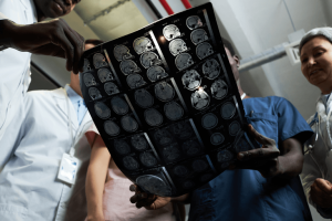 can-a-brain-tumour-cause-seizures-or-epilepsy
